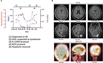 Autoimmune encephalitis followed by hemophagocytic lymph histiocytosis: a case report